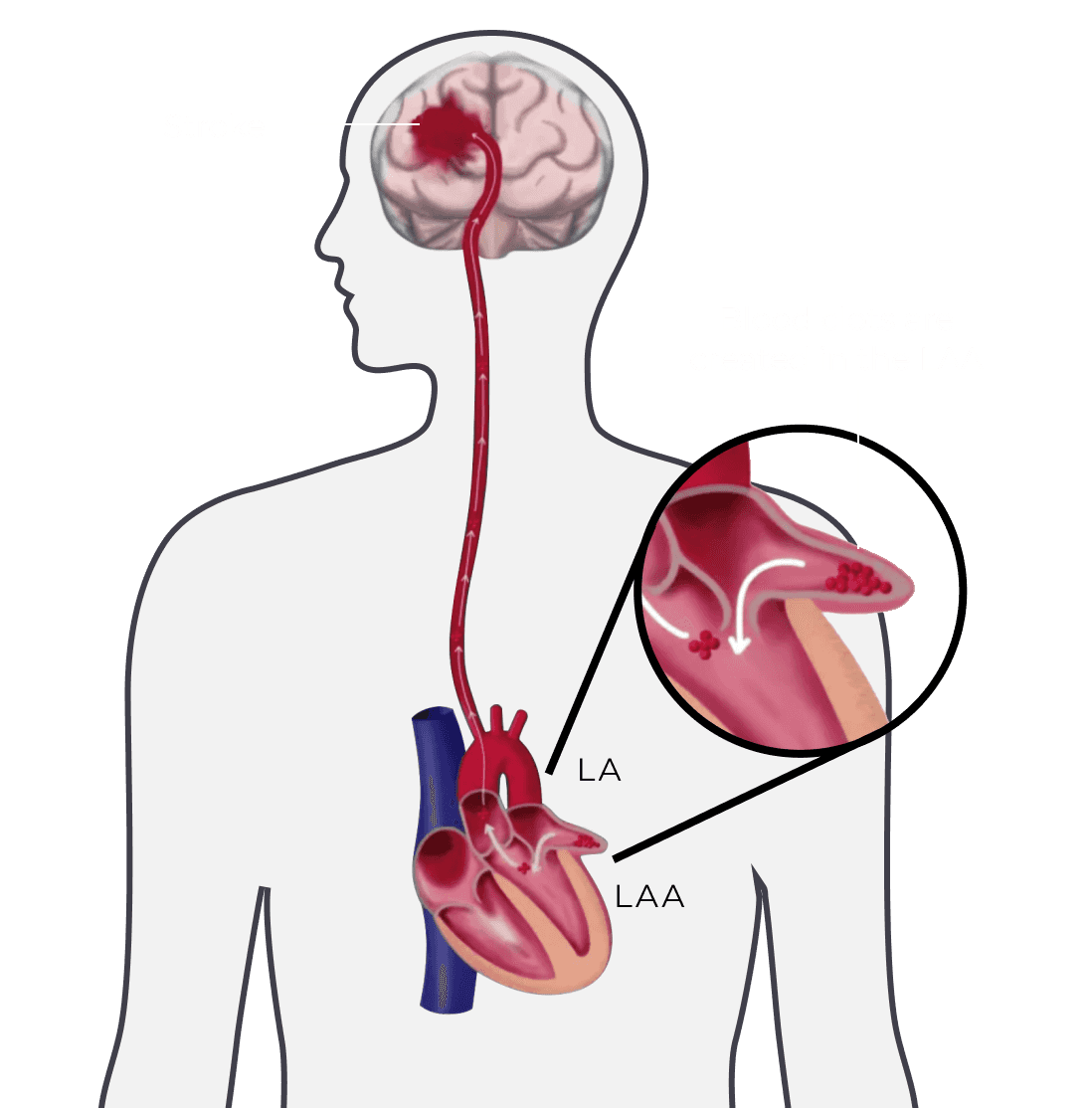 AtriClamp medical device 3D visualization